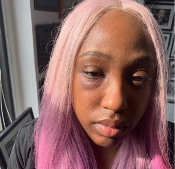 A rapper Brittney Taylor com os hematomas nos olhos em decorrência das agressões de Remy Ma (Foto: Instagram)