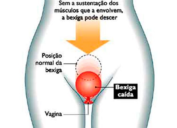 Como funciona a técnica do rejuvenescimento vaginal (Foto: Divulgação)