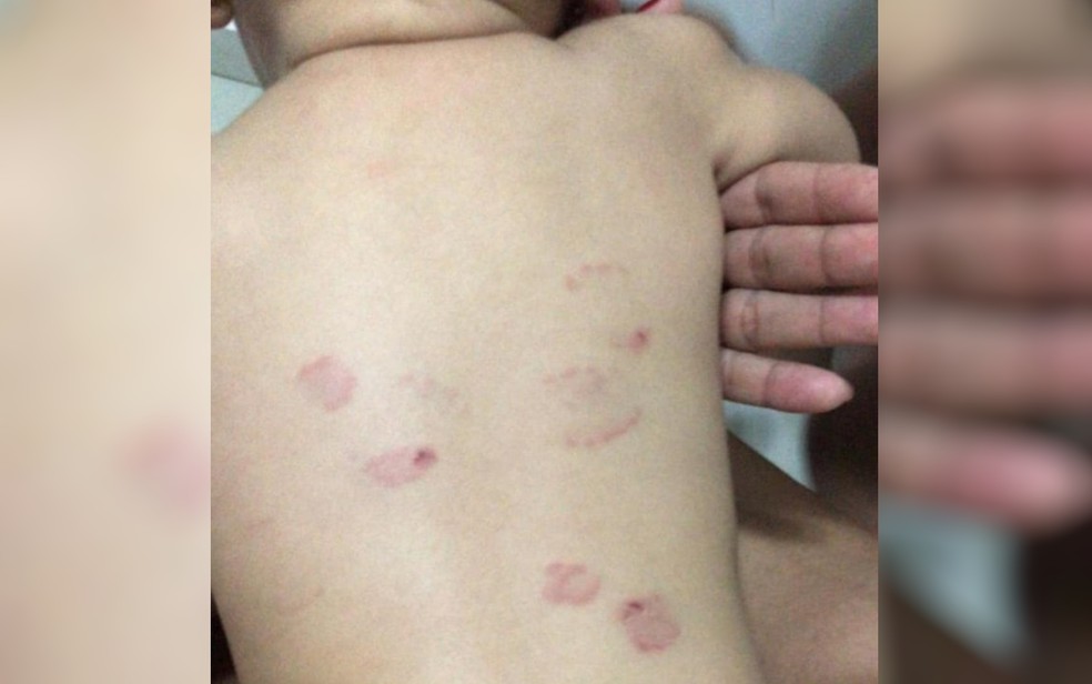 MÃ£e fotografou as marcas das mordidas nas costas da bebÃª, que teriam ocorrido em creche de Rio Verde â€” Foto: Arquivo Pessoal