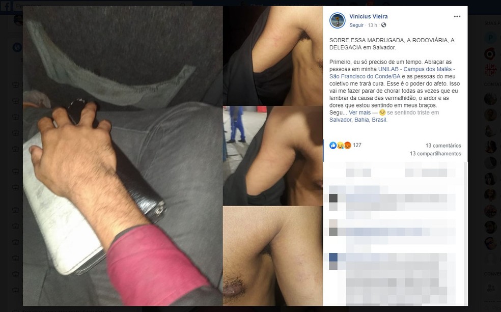 Jovem mostrou partes do corpo que ficaram feridos durante ação. — Foto: Reprodução / Redes Sociais