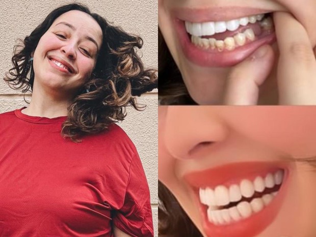 Camila Monteiro mostra antes e depois de tratamentos dentários (Foto: Reprodução/Instagram)