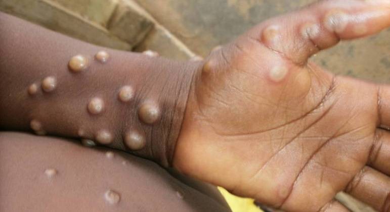O tempo de incubação do vírus – contato com um infectado até os primeiros sintomas surgirem – é entre 5 e 21 dias (Foto: OMS: Centro de controle de doenças da Nigéria)