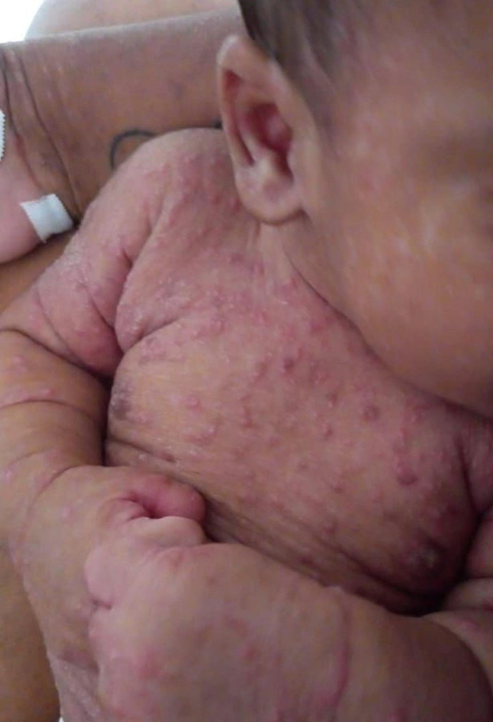 Bebê de apenas dois meses precisou ficar internado por uma infecção derivada da escabiose, conhecida como sarna humana — Foto: Reprodução/PG Invisível 