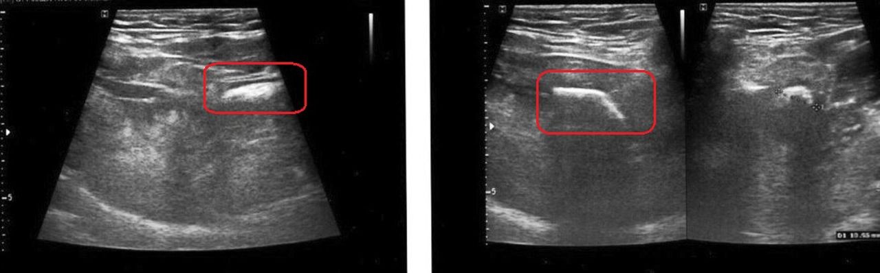 Médicos detectaram cálculo após ultrassonografia (Foto: Nilesh et al., BMJ, 2020)
