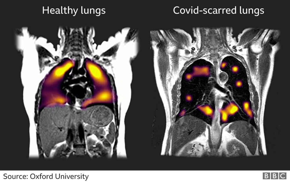 Covid-19: exame pioneiro mostra danos em pulmões 3 meses depois de infecção por coronavírus 6