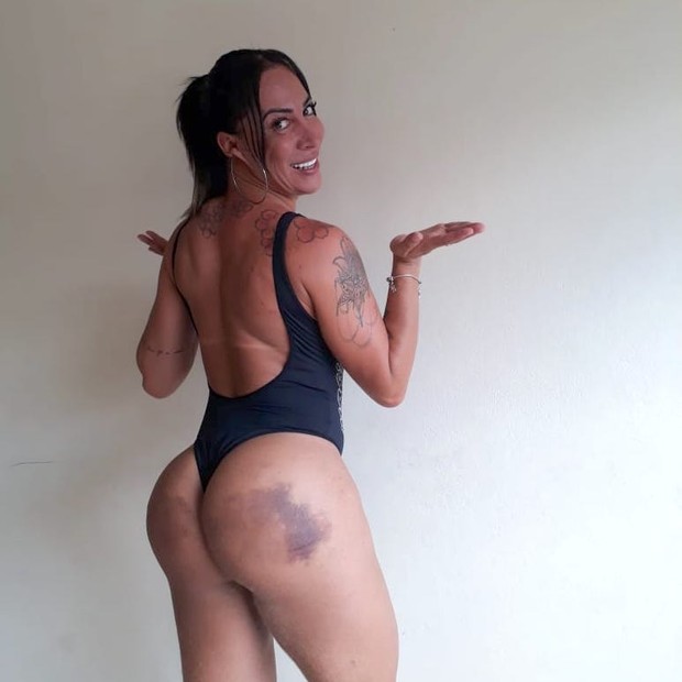 A ex-Miss Bumbum Pâmella Michelinny  mostra hematomas após procedimento (Foto: Divulgação)