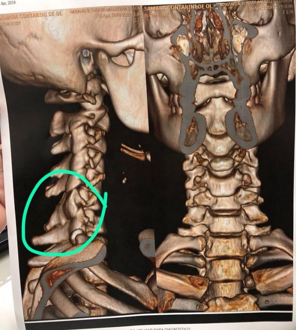 Raio-x aponta luxação na vértebra cervical da capixaba Samara Contarini (Foto: Divulgação/Arquivo Pessoal)