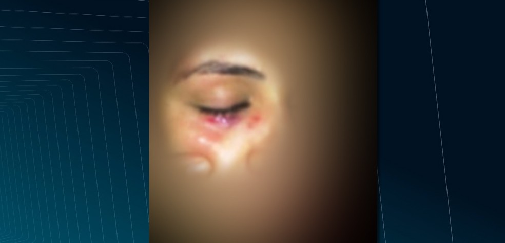 Jovem foi agredida com um soco no rosto, apÃ³s o rapaz ter insistindo para que ela danÃ§asse com ele, contra a vontade dela (Foto: ReproduÃ§Ã£o/TV ParaÃ­ba)