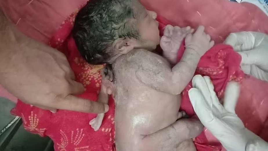 Criança indiana nasceu com terceira mão nas costas