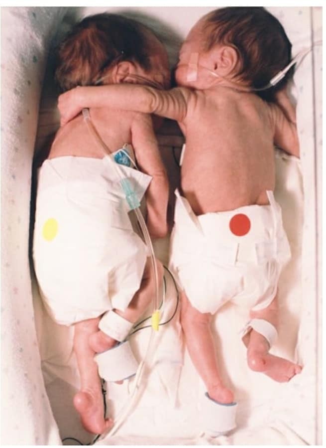 Abraço de irmã gêmea ajudou a salvar vida de bebê prematura (Foto: Reprodução/Facebook/Dr. Zulfiquar Ahmed)