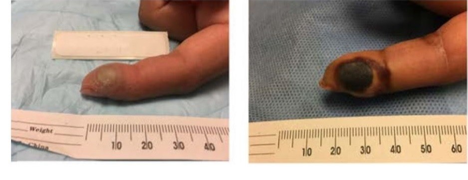 Cientistas acompanharam a evolução da doença: à direita, o dedo da mulher após algumas semanas de contaminação (Foto: Divulgação)