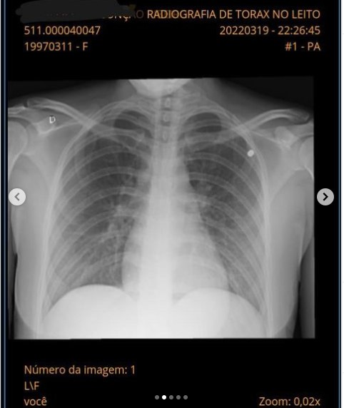 Raio-x mostra chumbinho que foi disparado contra foliona na Praça Paris alojado no corpo dela