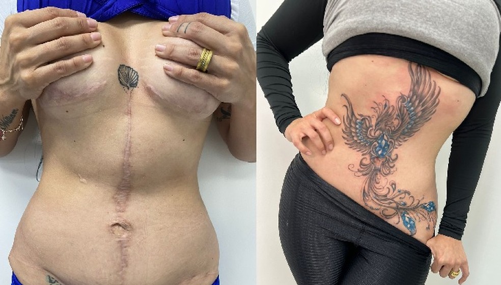 Mulher que foi vtima de violncia cobriu cicatrizes de uma cirurgia com tatuagem  Foto: Divulgao/Projeto We Are Diamonds