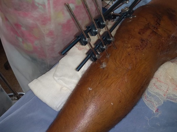 Paciente Com Perna Quebrada Diz Que Espera Ha Um Ano Por Cirurgia No Hospital Geral De Rr Roraima G1