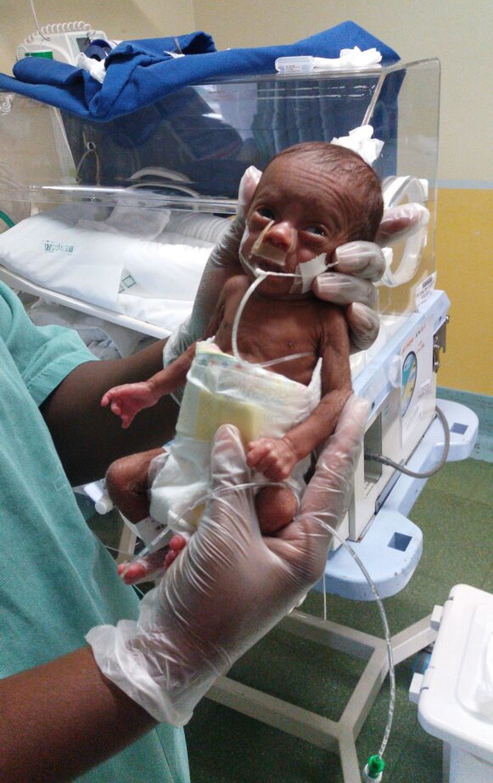 Pequena Ana Luiza nasceu em fevereiro pesando apenas 560 gramas (Foto: Santa Casa de Juiz de Fora)