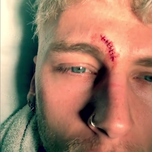 O músico Machine Gun Kelly com os pontos que precisou fazer para fechar o corte em sua testa (Foto: Instagram)