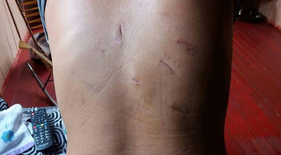 Marcas das 18 facadas ficaram por todo o corpo da camareira esfaqueada pelo ex que não aceitava fim do relacionamento (Foto: Arquivo pessoal )