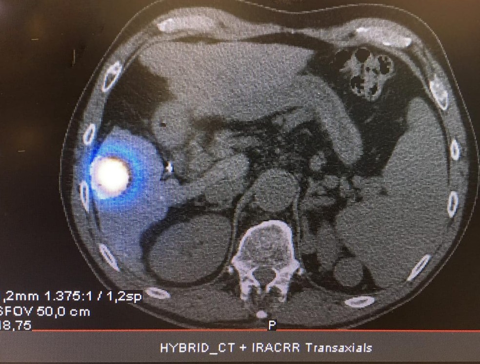 Técnica para tratar câncer de fígado foi feita pela primeira vez de forma gratuita em Botucatu — Foto: HCFMB/Divulgação