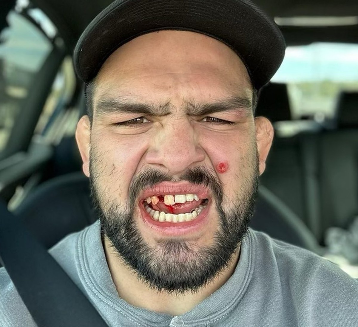 Gastelum publica vídeo de lesão na boca que o tirou de luta e mostra