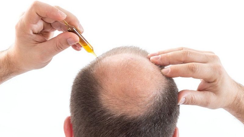 De acordo com a SBD, não há uma forma de prevenir a alopecia por se tratar de uma doença cujas causas são desconhecidas (Foto: Getty Images via BBC News)
