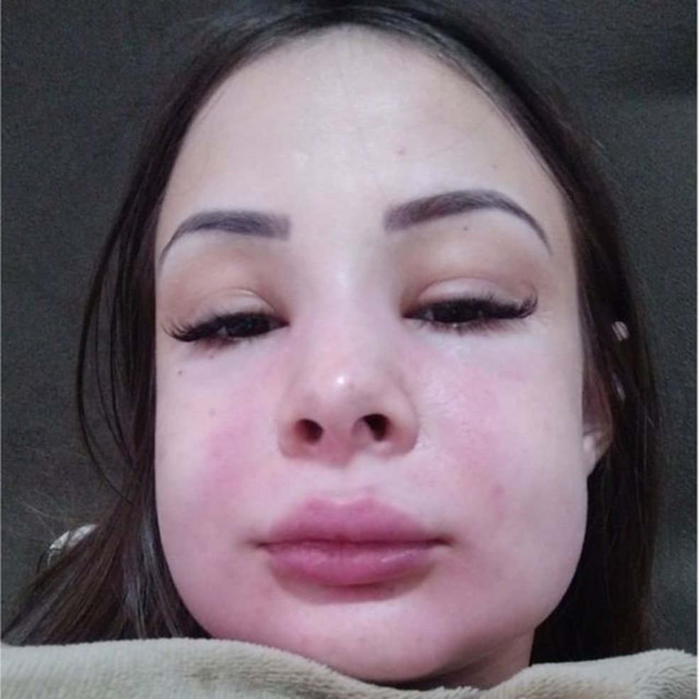 Mesmo recebendo medicação, o inchaço não passou por completo e Pamela só voltou a ter o rosto "normal" depois de quase oito dias — Foto: ARQUIVO PESSOAL/BBC