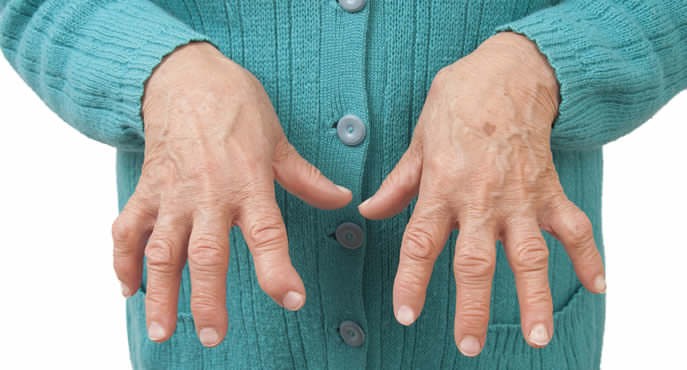 Pacientes com artrite reumatoide (AR) passar por pelo menos quatro médicos até descobrirem a doença (Foto: OPAS)