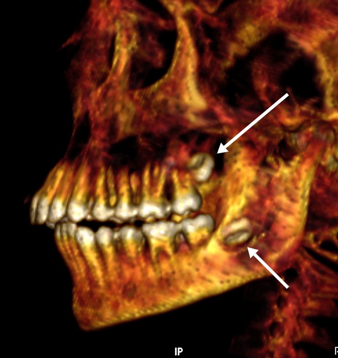 Arcada dentária da múmia, pela qual visualizou-se os sisos não irrompidos e foi possível estimar a idade do jovem embalsamado — Foto: Divulgação/SN Saleem, SA Seddik, M el-Halwagy
