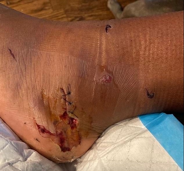 O pé ferido da cantora Megan Thee Stallion após ela ser alvo de um tiro (Foto: Instagram)