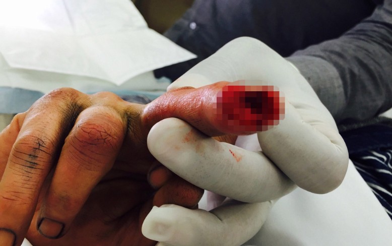 Imagem da lesão de Johnny Depp sofrida na Austrália (Foto: reprodução)