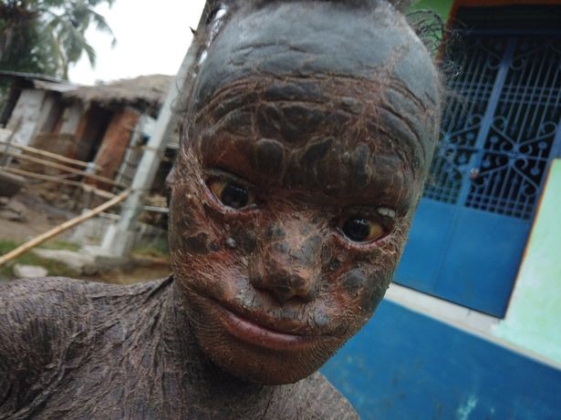 Ictiose lamelar, a condição que faz este menino ter "pele de cobra" (Foto: Reprodução The Daily Mirror)