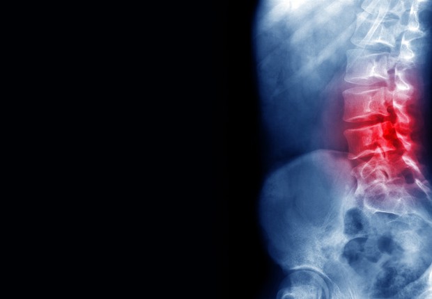 medula, coluna, costas, dor, dor nas costas, ossos, espinha, medicina,  (Foto: Getty Images)