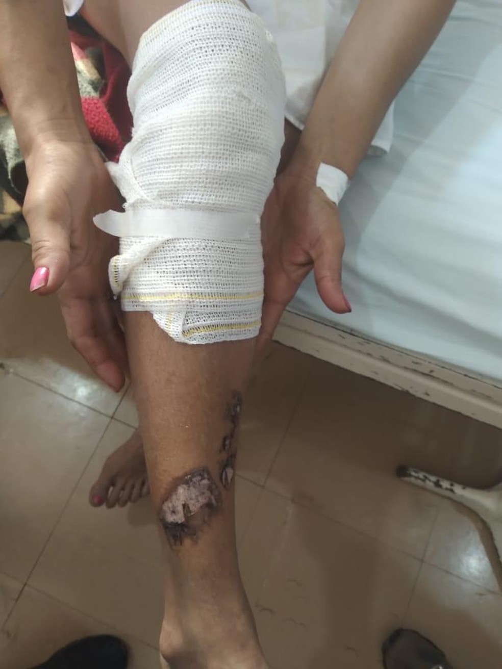 Mulher sofreu queimaduras pelo corpo após ser jogada em uma fogueira de uma festa junina realizada neste domingo (27) em um sítio na zona rural de Dom Aquino (MT) — Foto: PMMT