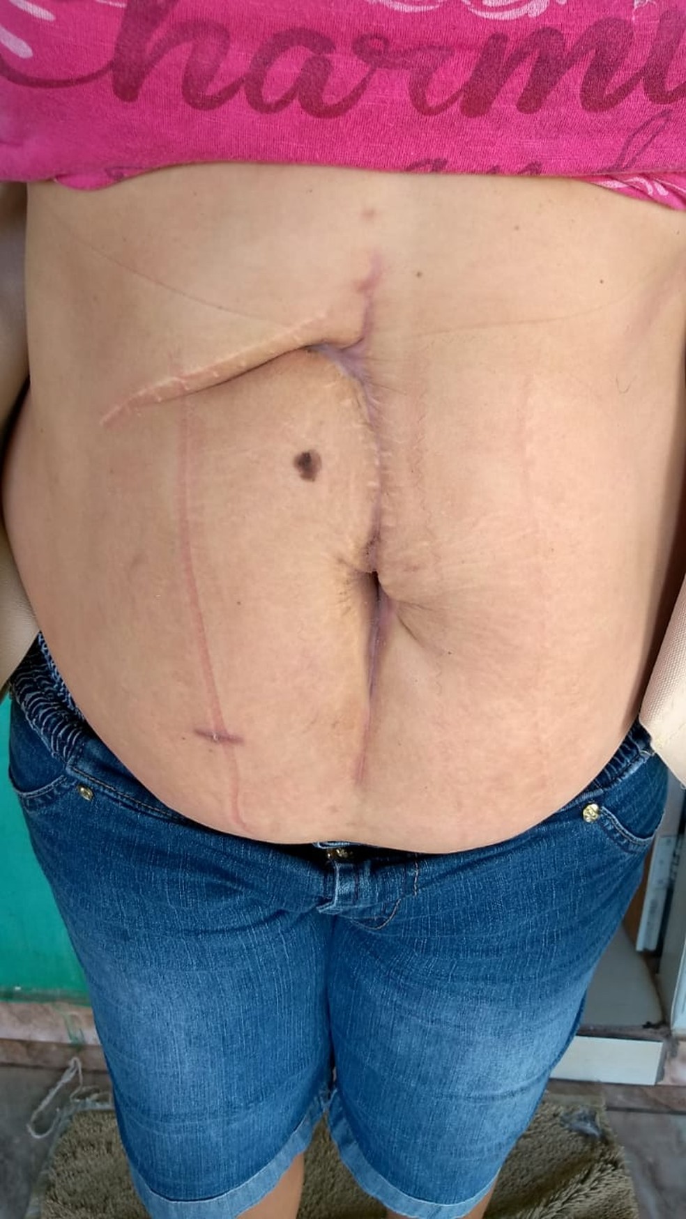Sirlei mostra a cicatriz da cirurgia  Foto: Arquivo Pessoal