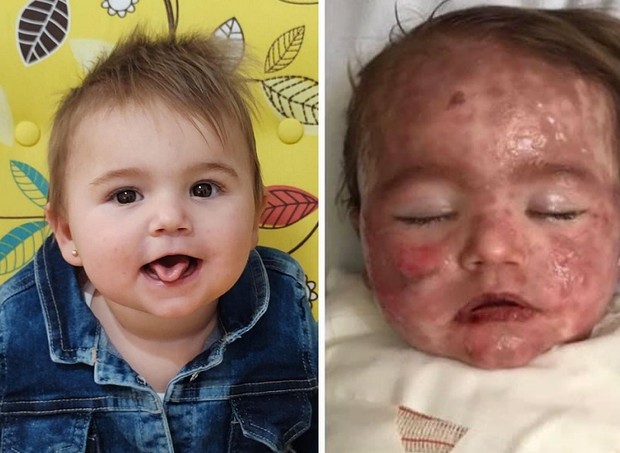 Helena antes e depois da condição que cobriu sua pele de lesões (Foto: Reprodução/Facebook)