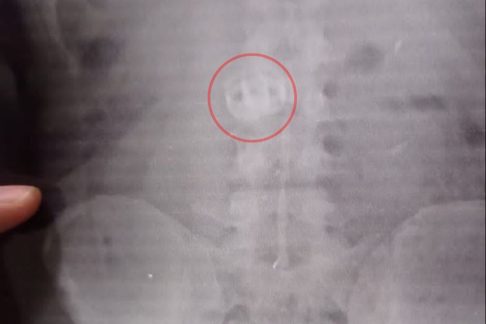 Criminoso engoliu alianças de vítimas para recuperá-las depois do assalto, mas acabou preso e dedurado por Raios X — Foto: Divulgação