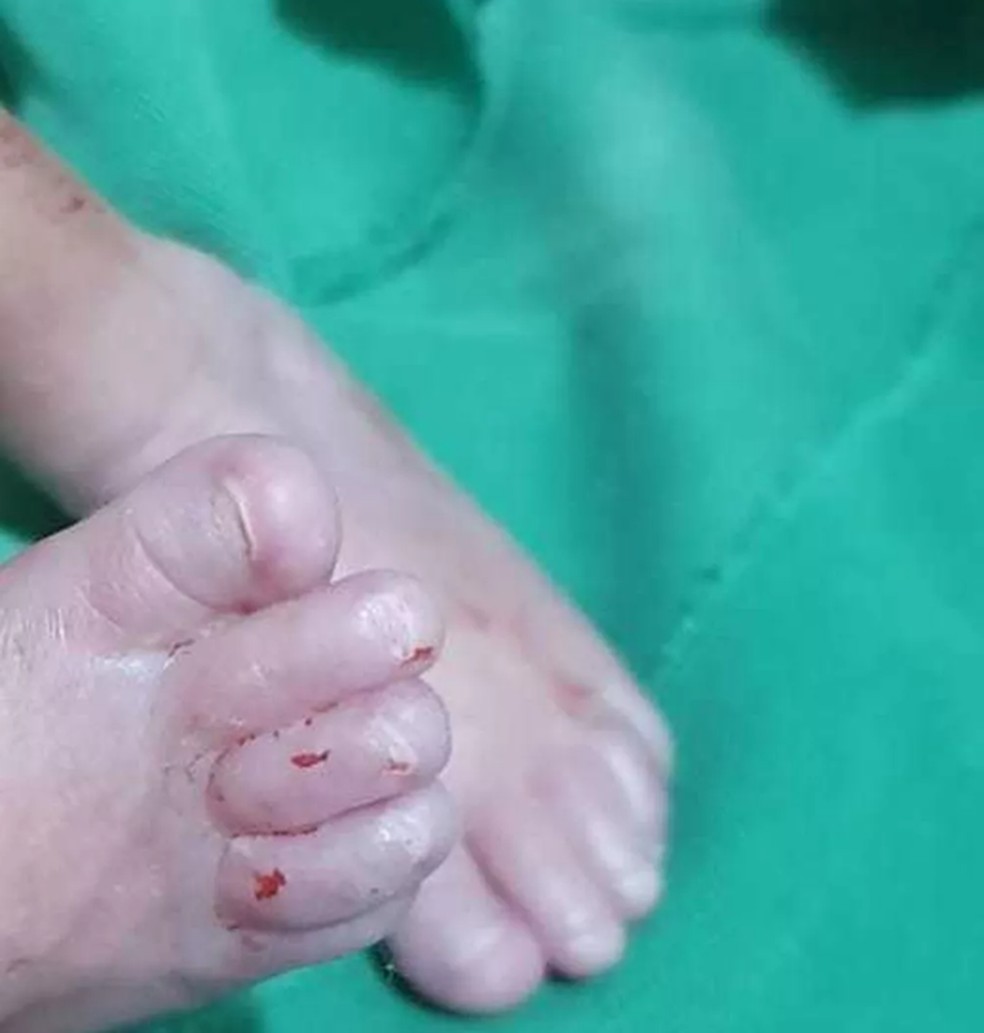 Bebê nasceu prematuro em Ariquemes — Foto: Reprodução