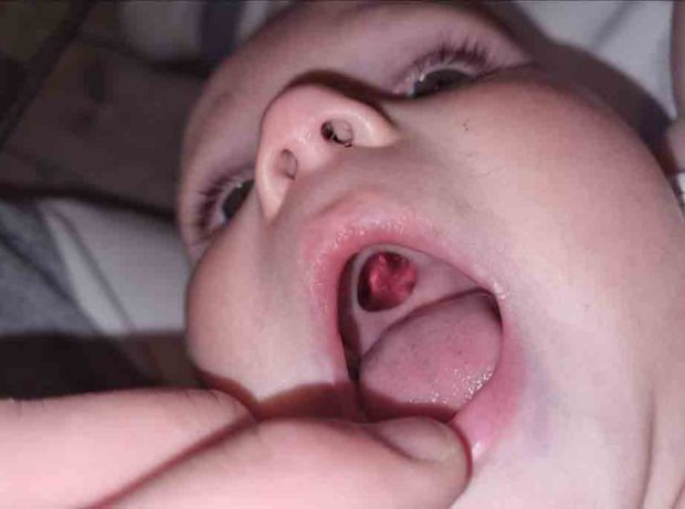 Mãe entra em pânico ao notar o que parece ser um buraco na boca de bebê (Foto: Reprodução/The Sun)