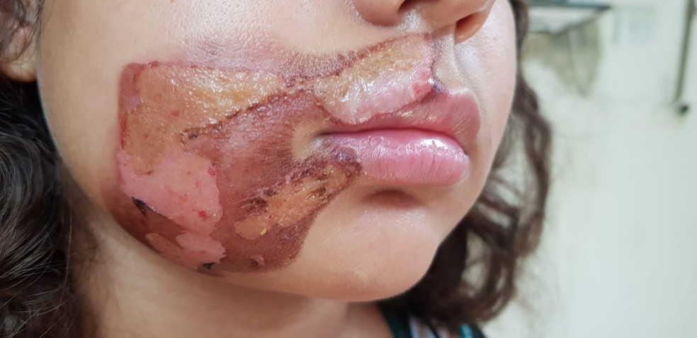 Criança foi queimada no rosto em Olinda — Foto: Conselho Tutelar de Olinda/Divulgação