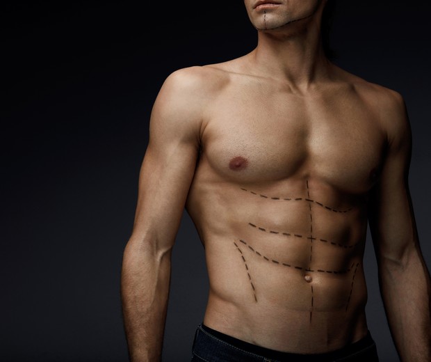 Man Sexy Body With Black Lines On Skin. Closeup Of Beautiful Fit Muscular Male Torso With Pencil Surgical Marks On Abs Before Plastic Surgery, Beauty Operation On Black Background. High Resolution (Foto: Getty Images/iStockphoto)