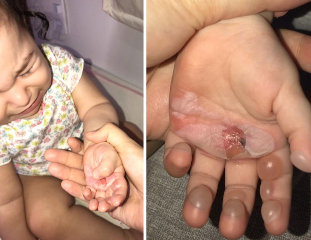 Um mês depois, as mãos de Catarina já estavam quase que completamente curadas (Foto: Arquivo pessoal)