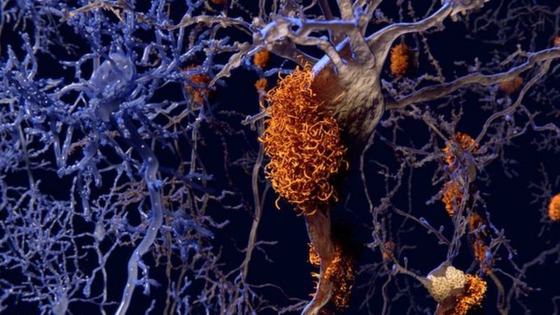 Pelo que se sabe até o momento, a doença se inicia com a deposição da proteína beta-amiloide (representada na cor laranja na ilustração) do lado de fora dos neurônios (Foto: Science Photo/ Getty Images via BBC News)