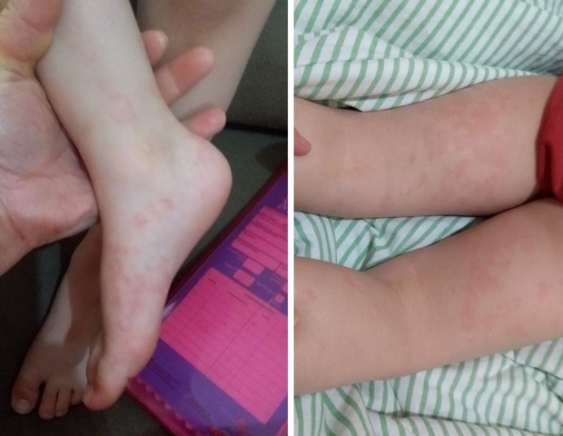 Manchas vermelhas no corpo de crianças podem ser sinais de covid? (Foto: Arquivo pessoal)