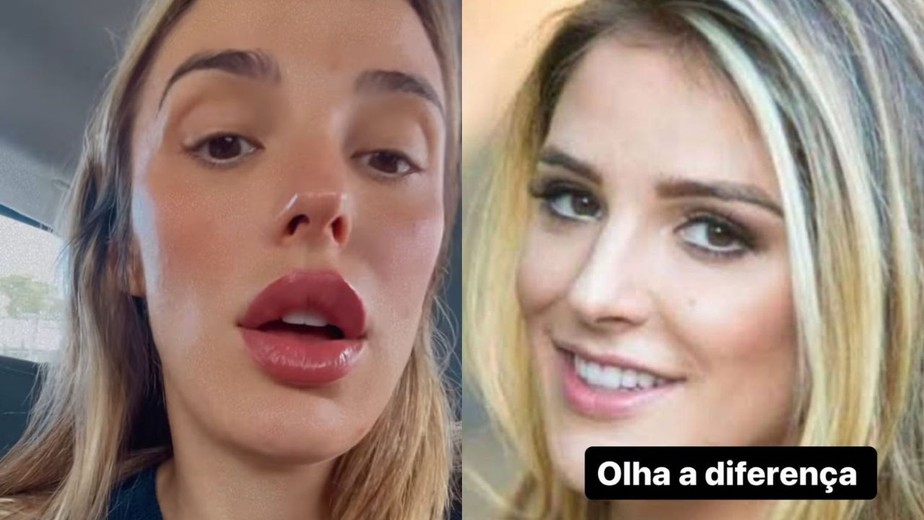 Rafa Brites faz procedimento para dar volume aos lábios; compare ...