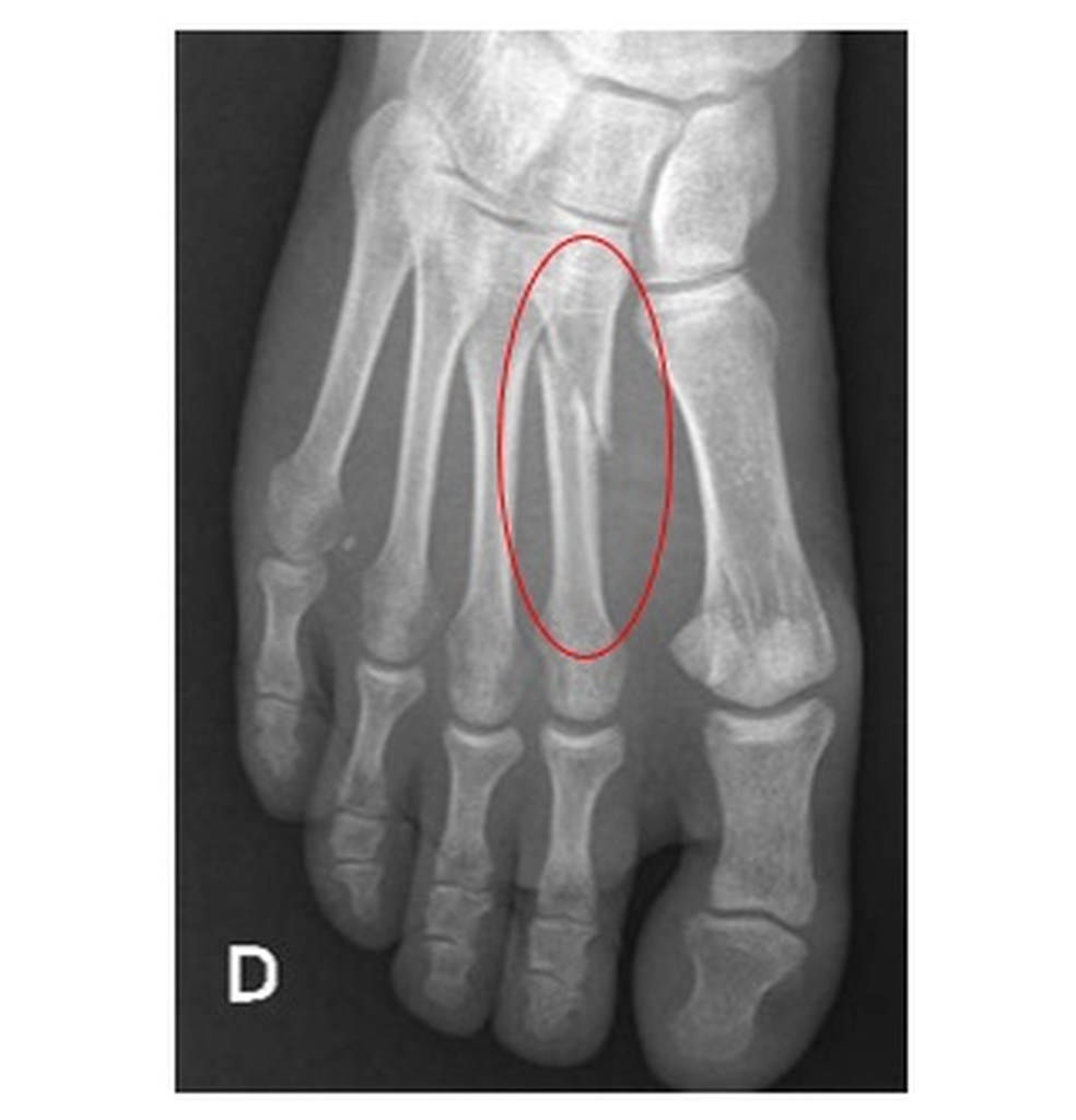 Fratura Por Stress Do Metatarso Especialista Indica Melhor Momento Para Operar Saude Ge
