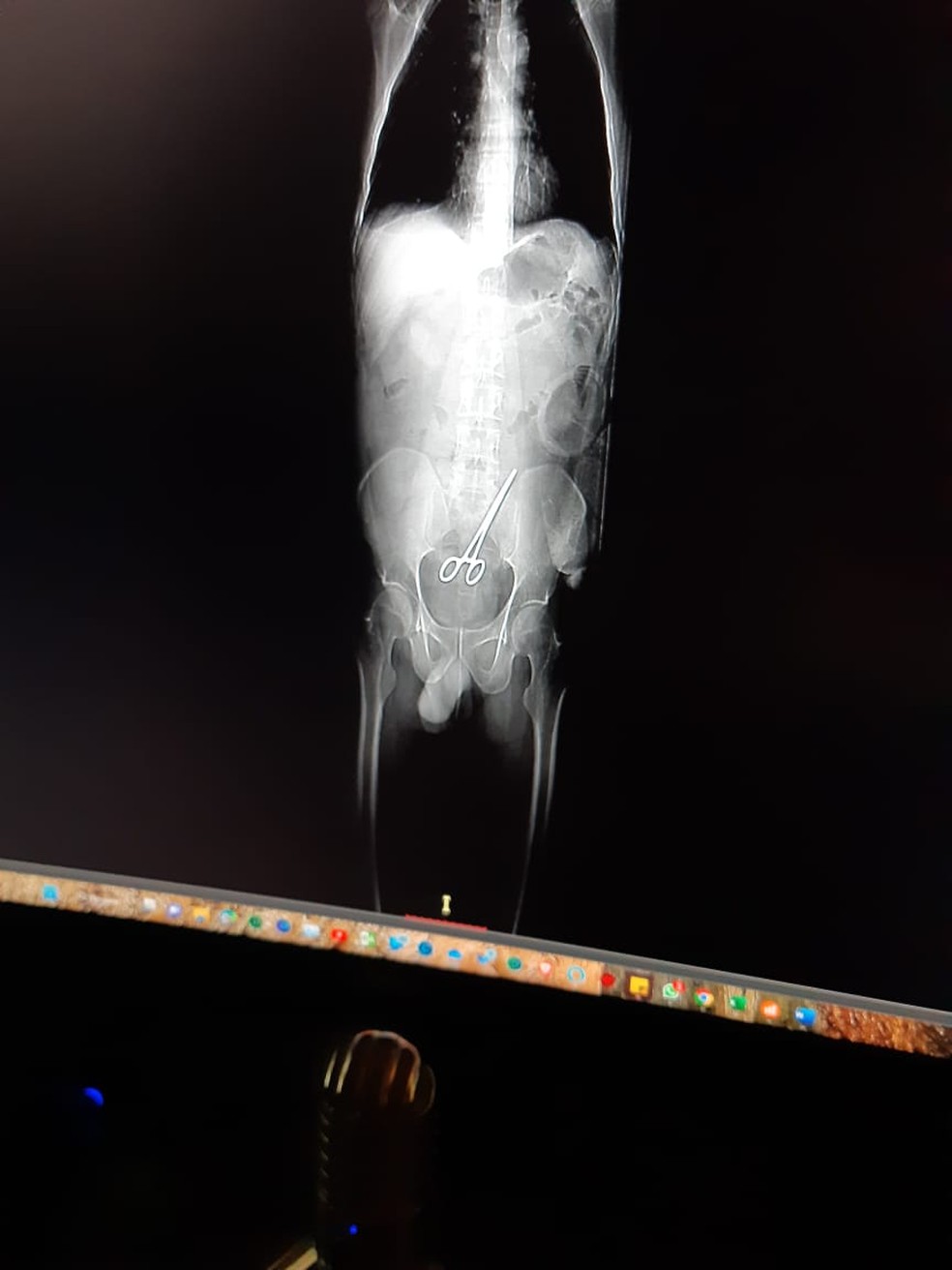 Tomografia mostra tesoura 'esquecida' dentro de vereador — Foto: Cedida