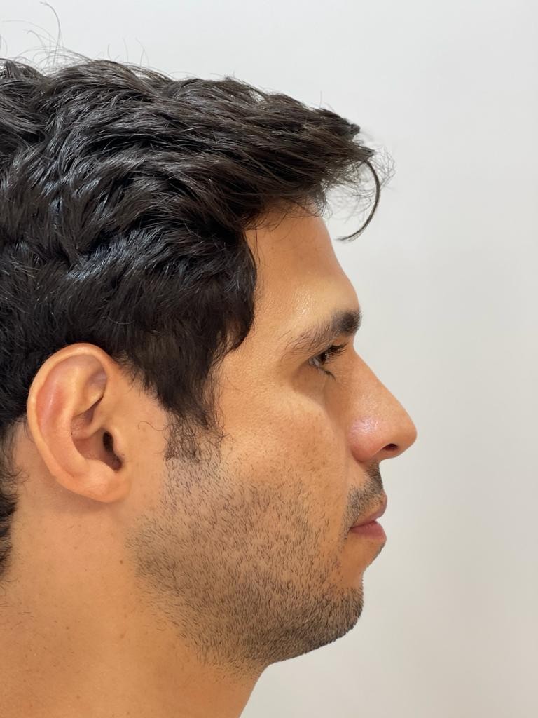 Rodrigo Mussi antes de fazer harmonização facial (Foto: Divulgação )