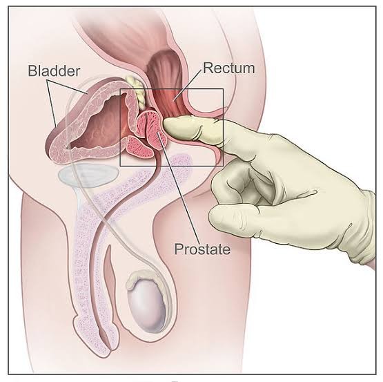 Imagem exibe o procedimento do exame que avalia a saúde da próstata (Foto: Wikimedia Commons)