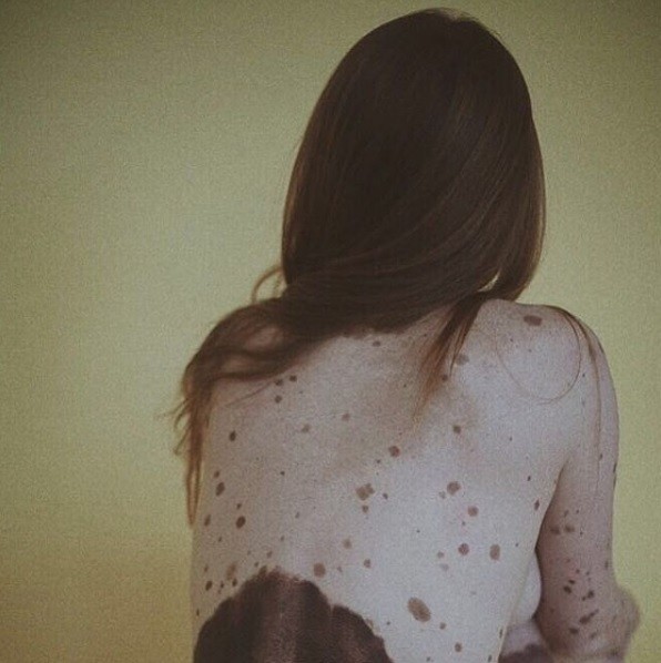 Alejandra Savoia, espanhola, recebeu convite para mostrar suas manchas nas costas (Foto: Reprodução/ Instagram/ @alejandrasavoia)