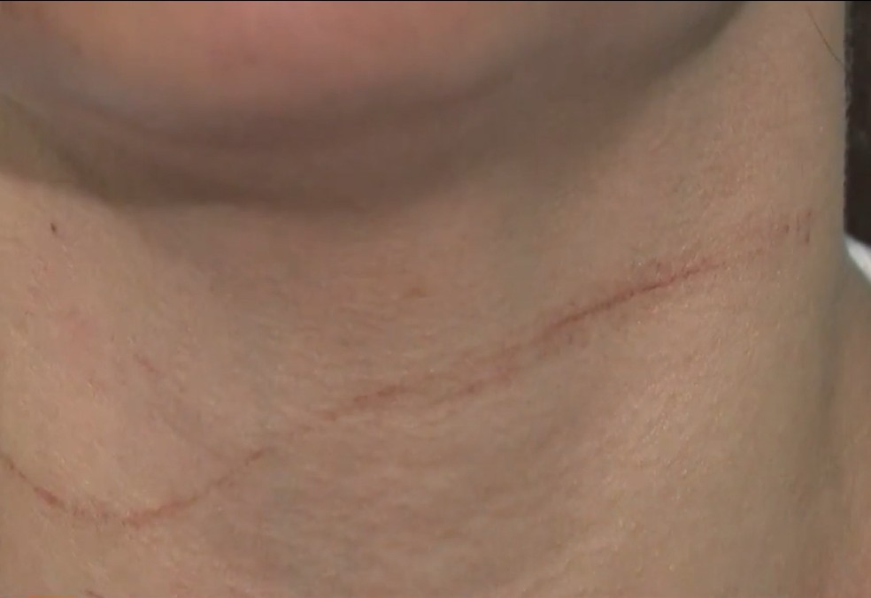 Mulher ficou com a marca no pescoço do fio com que o marido a enforcou — Foto: Reprodução/TV Gazeta