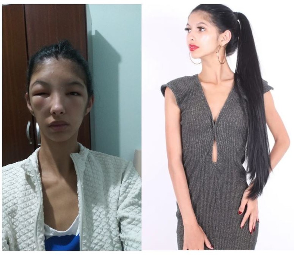 Luisa Kamei pintou o cabelo e teve reação alérgica com tintura — Foto: Redes sociais/Reprodução